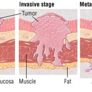 Cancer du muscle