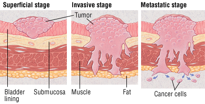 cancer du muscle