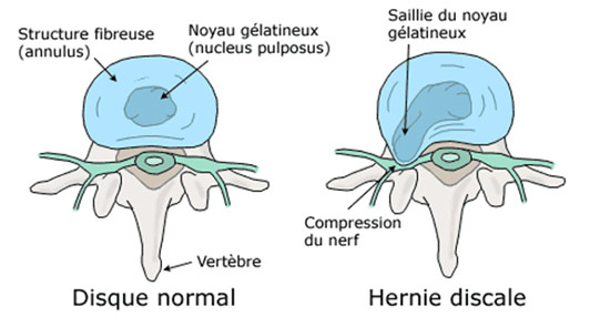 hernie discale musculation