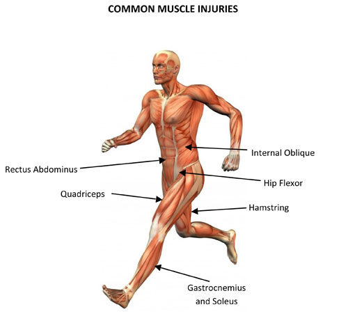 muscle injury