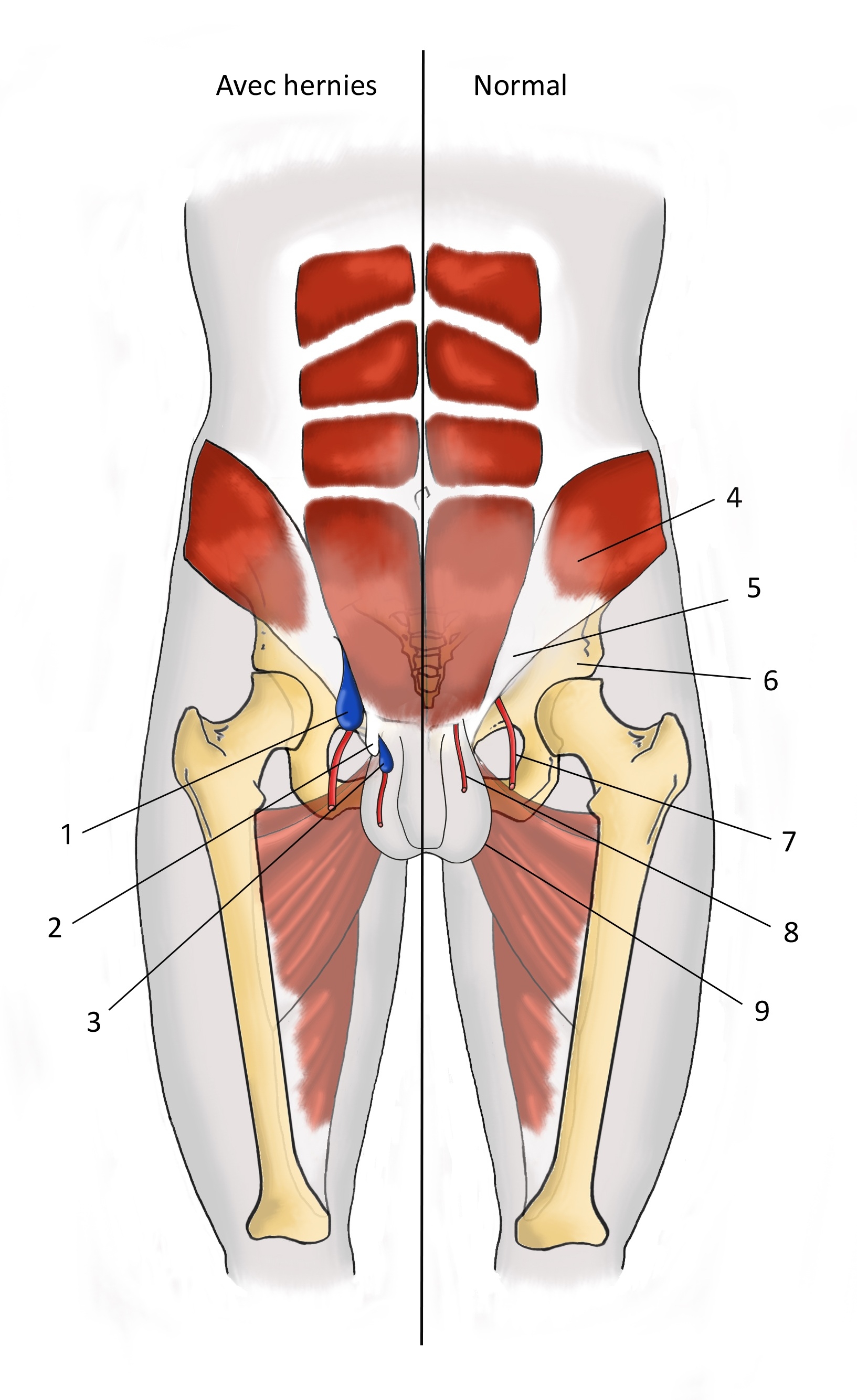 hernie inguinale musculation abdominaux